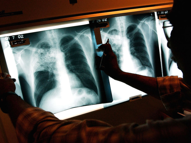 Tuberculosis cases reported at Central San Diego and Spring Valley schools