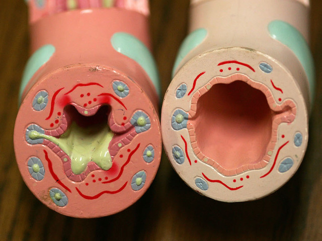 Vitamin D could help manage asthma, study says