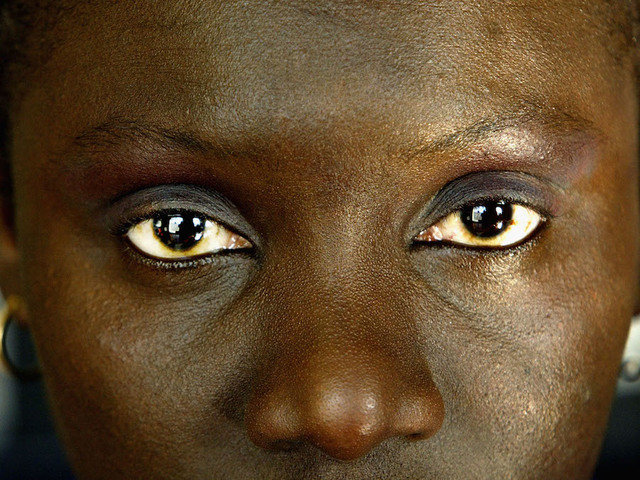 Female genital mutilation on rise in America